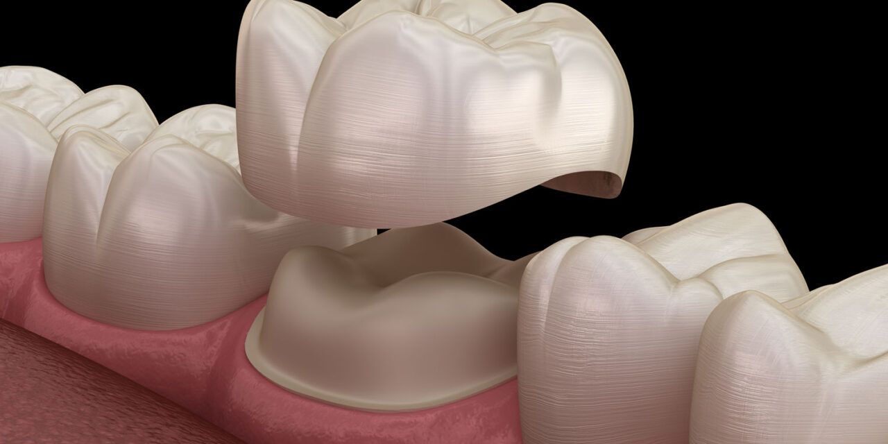 Dental Crowns in Mexico: The Best Option for Americans
