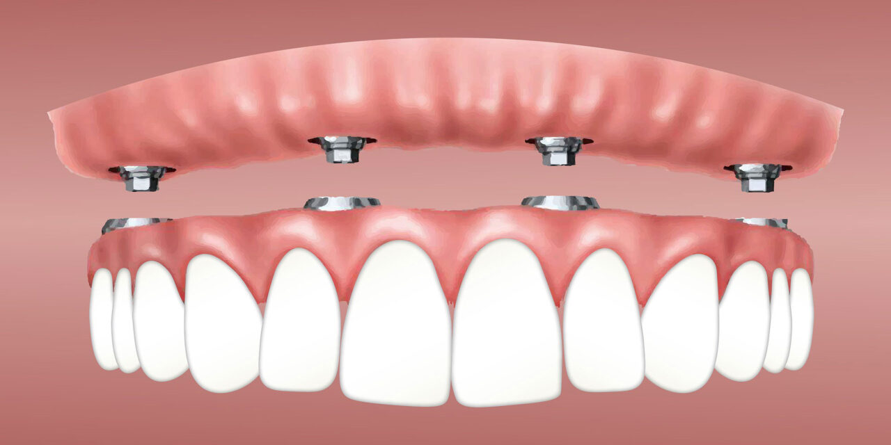 How Much Are Dental Implants in Mexico?