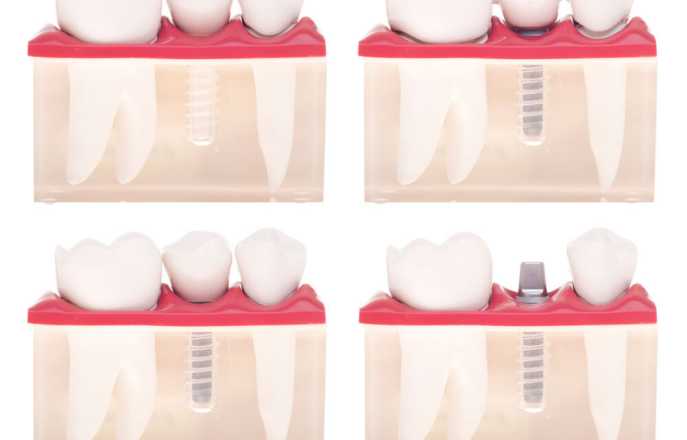 Dental Implants Prices in Cancun, Mexico