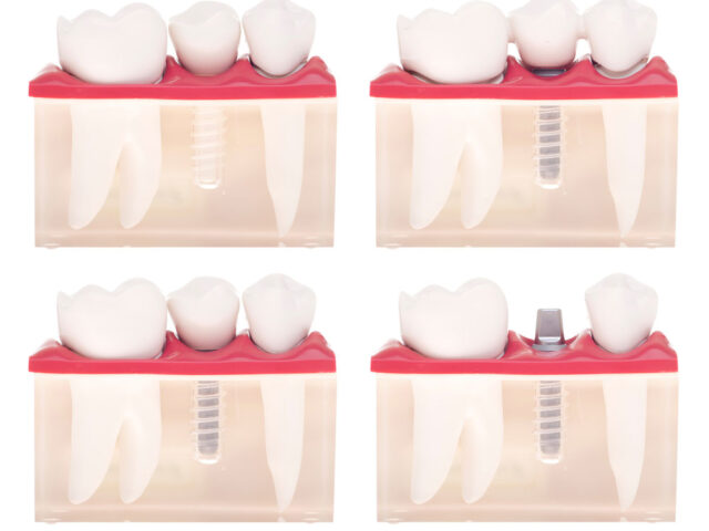 Dental Implants Prices in Cancun, Mexico