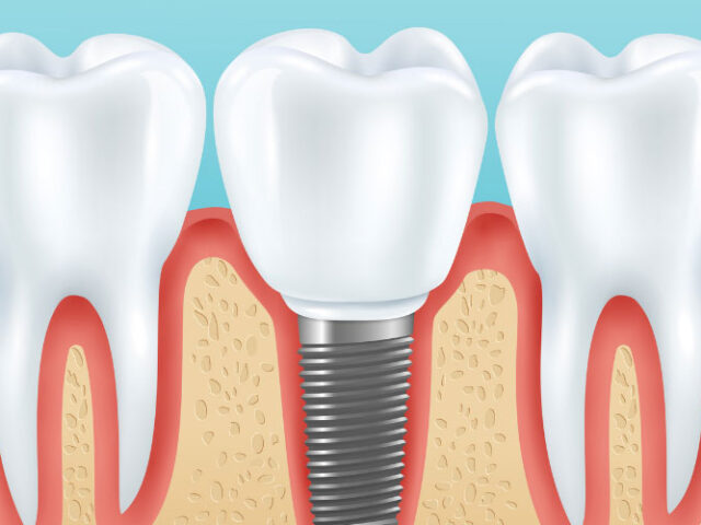 What is the Cost of Dental Implants in Mexico?