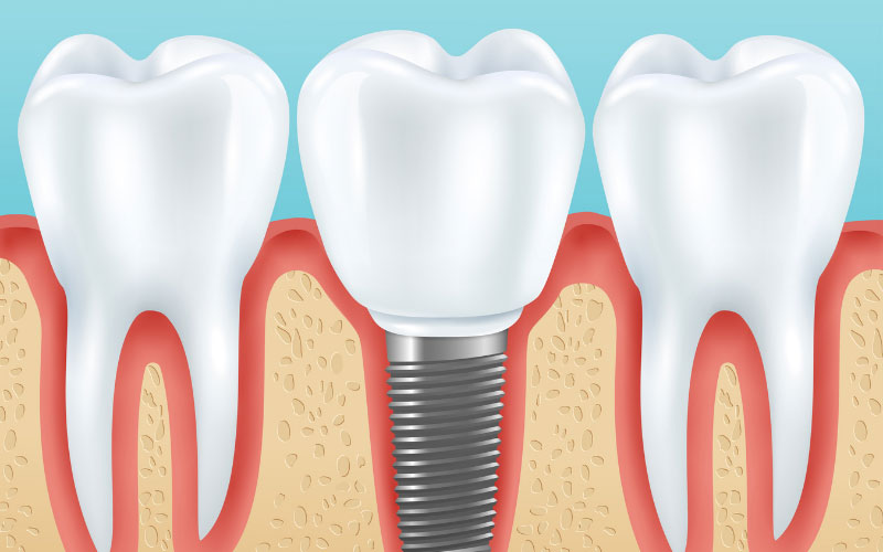 What is the Cost of Dental Implants in Mexico?