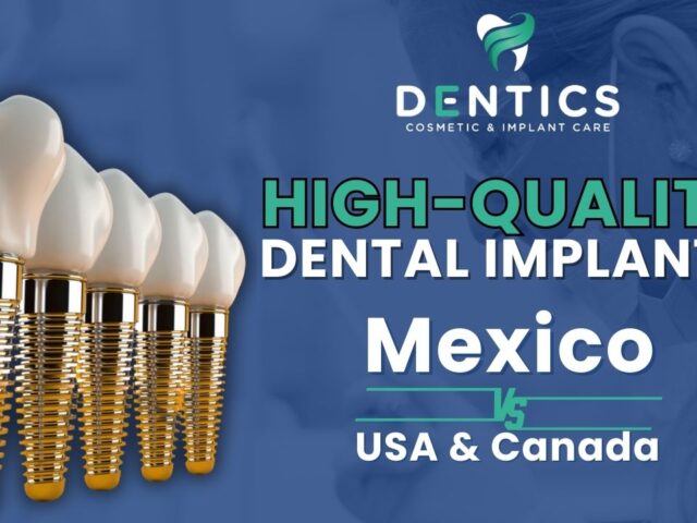 High-Quality Dental Implants in Mexico vs. USA and Canada