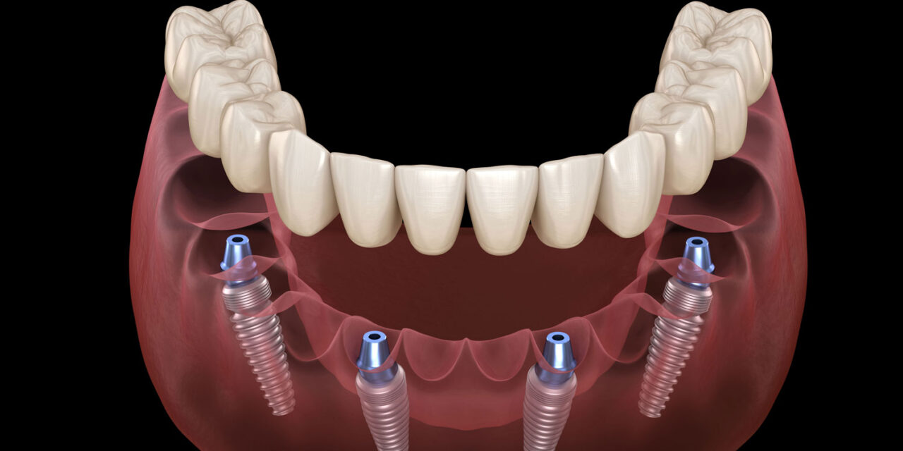 How much do All On 4 Dental Implants Cost in Cancun?