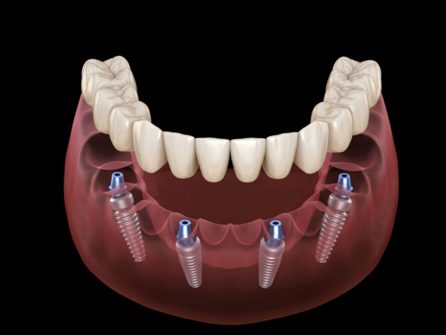 How much do All On 4 Dental Implants Cost in Cancun?