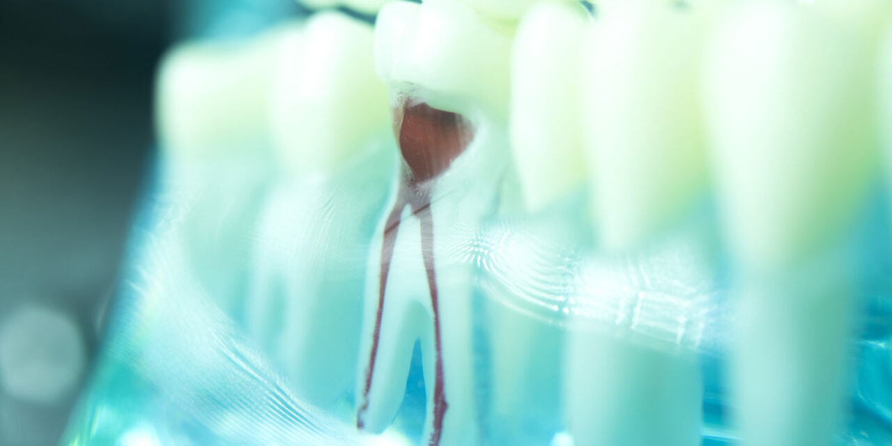 Need a Root Canal? Did you Know Mexico is Your Best Option?